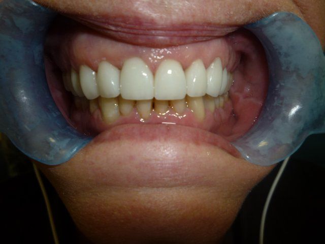 Invisalign Versus Braces – Dentist Advice